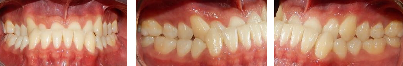 Fig.4 Intraoral de frente / Lateral derecha / Lateral izquierda