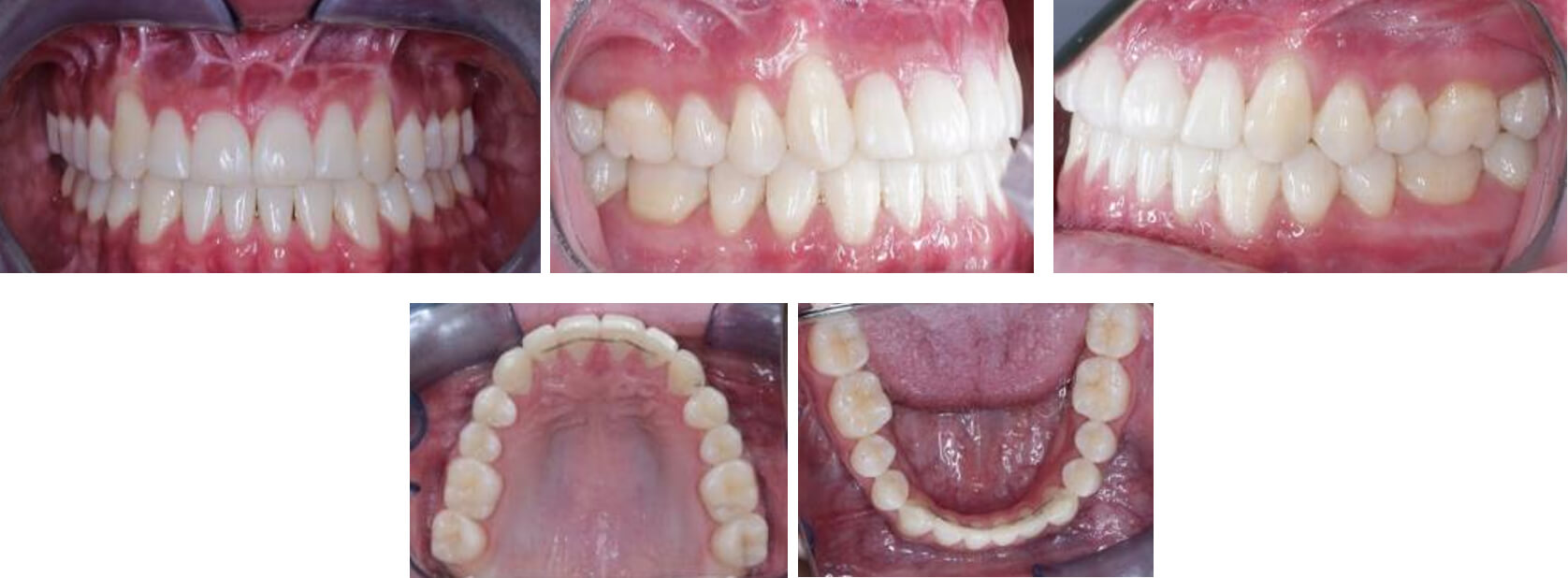 Fig. 14. Frente intraoral, lateral derecha, izquierda, vista oclusal superior e inferior