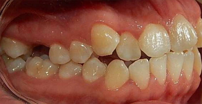 Fig.2 Intraoral derecha