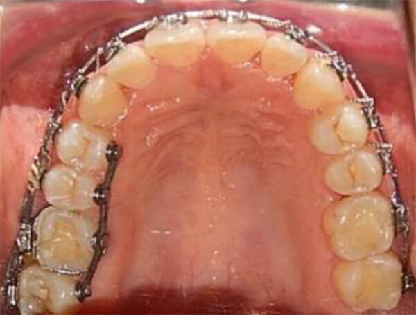 Fig. 8 Oclusal superior con cadenas elastomericas