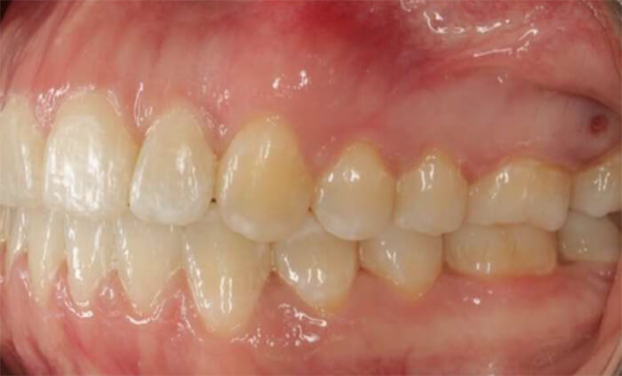 Fig. 12. izquierda final