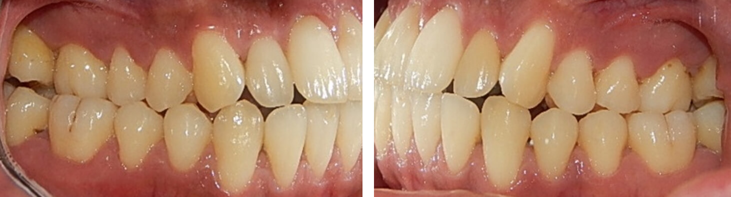 Fig. 4 Intraoral lateral derecha e izquierda