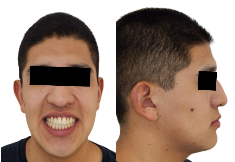 Fig. 9. Extraorales finales