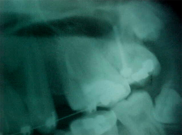 Fig. 12