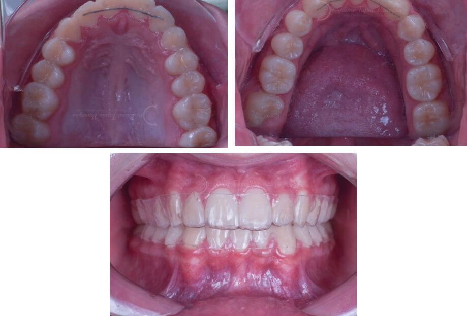Fig.12 Vista oclusal de los retenedores fijos superior e inferior y de frente con los retenedores termoformados.