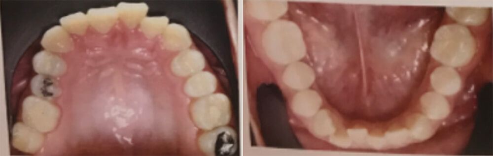 Fig. 4 Vista oclusal superior inferior