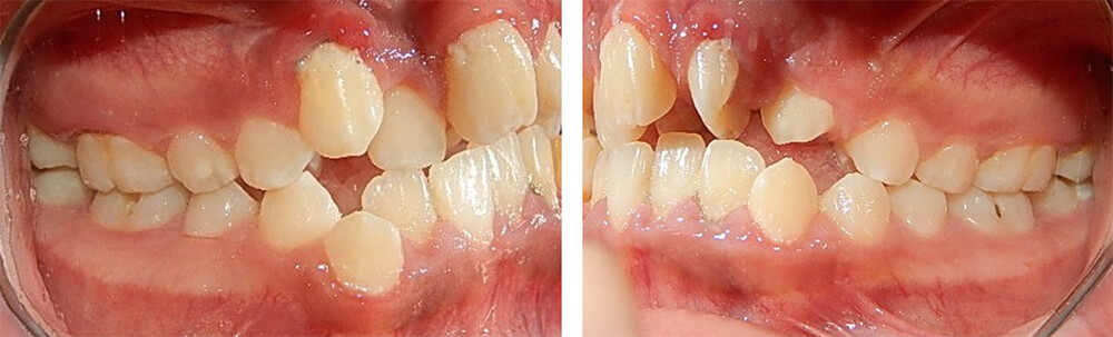 Fig. 10 lateral derecha e izquierda clase II molar bilateral
