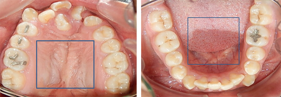 Fig. 11 Vista oclusal superior e inferior