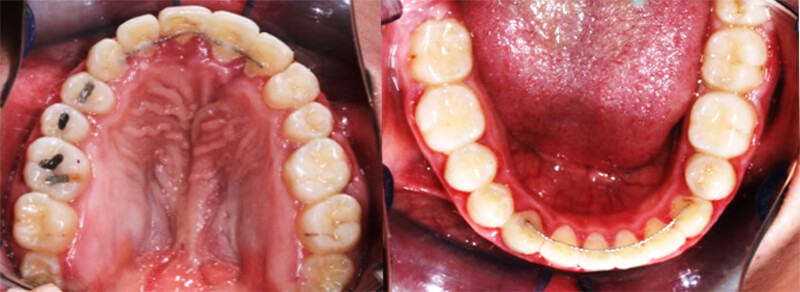 Fig. 13 Vista oclusal superior e inferior finales