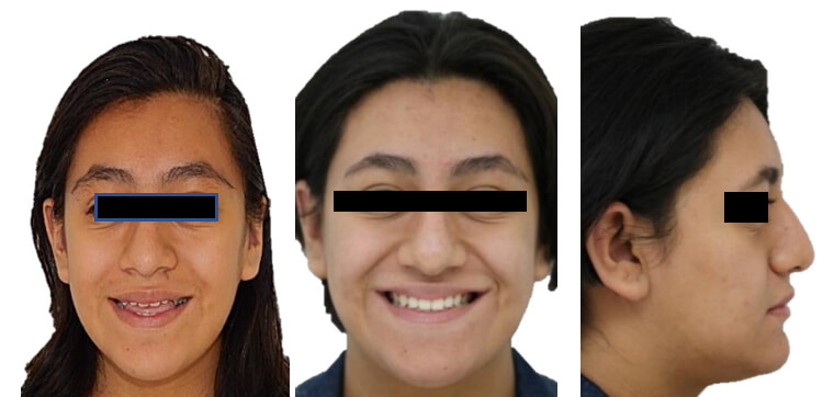 Fig. 9. Intraoral de frente