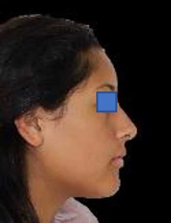 Fig 2 perfil
