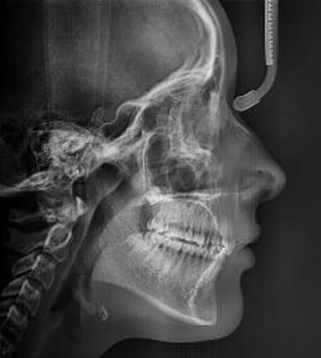 Fig.5 Radiografía lateral de cráneo inicio