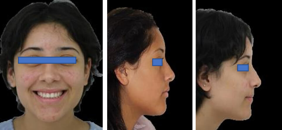 Fig.8 Extraorales de frente sonrisa, perfil final