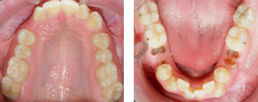 Fig. 4. Vista oclusal en la inferior los restos radiculares de los OD. 75 y 85 la agenesia del 35 y 45