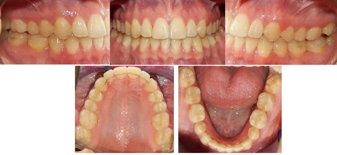 Fig. 10 intraorales de frente, lateral derecha e izquierda y oclusales
