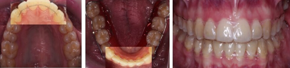 Fig. 12 retenedores fijos de 3 a 3 en superior e inferior y un retenedor termoformado superior e inferior.