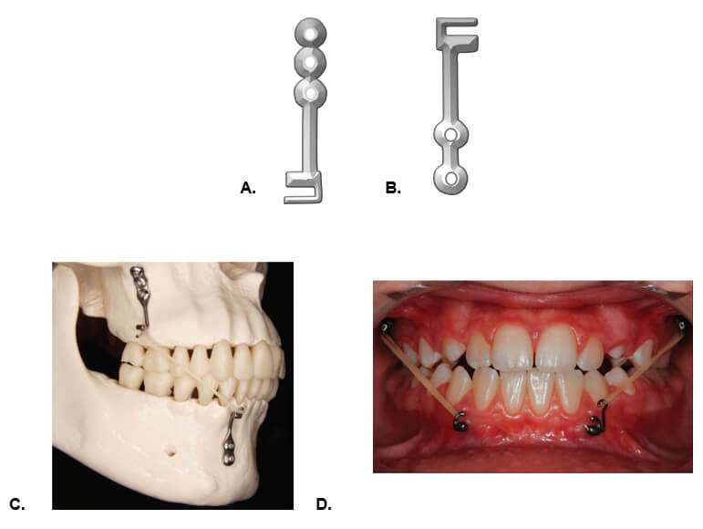 Figura. 4. Miniplacas modificadas en su porción distal, para recibir el elástico intermaxilar. A. Miniplaca con tres orificios para el maxilar superior. B. Miniplacas con dos orificios para el maxilar inferior. C. Miniplacas modificadas en su porción distal, instaladas en los respectivos sitios anatómicos, que reciben los elásticos intermaxilares, que va de una miniplaca en el maxilar a otra en la mandíbula 19. D. Fotografía clínica que muestran las Miniplacas modificadas en su porción distal, mismas que reciben los elásticos intermaxilares, que va de una miniplaca en el maxilar a otra en la mandíbula, en el lado derecho e izquierdo 19.