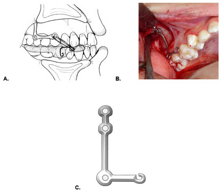 Figura. 5. A. Miniplacas en forma de L, modificadas en su porción distal, para recibir el elástico intermaxilar, que va de una miniplaca en el maxilar a un aparato de acrílico en la mandíbula. B. Fotografía clínica que muestra las Miniplacas en forma de L, modificadas en su porción distal, instaladas en la superficie ósea del contrafuerte infra cigomático con dos minitornillos para recibir el elástico intermaxilar. C. Miniplacas en forma de L, modificadas en su porción distal 5.