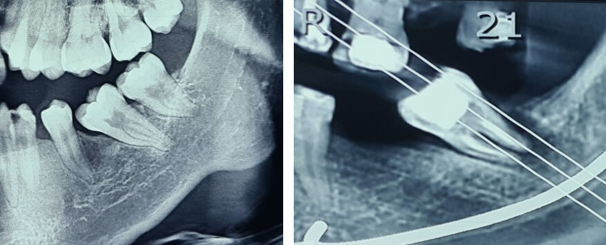 Figura 1: A. muestra la inclinación del segundo molar radiografía panorámica. B. Pieza inclinada con su eje inclinado Fuente: propia