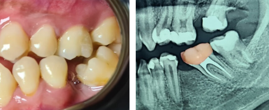 Fig.2 A. Fotografía intraoral presencia de bacteriana y bolsas periodontales por la inclinación del segundo molar inferior permanente. B mesioinclinación del segundo molar en Radiografía Panorámica. Fuente: propia