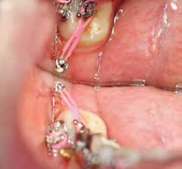 Figura 7. Microtornillo colocado para verticalizar segundo molar. Fuente: tomado de Benavidez Cruz microimplantes una nueva opción en el tratamiento de ortodoncia
