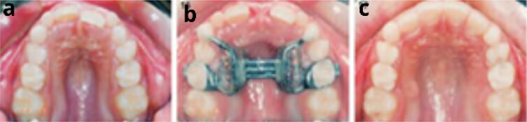 Figura 2. Tratamiento: Expamsion transversal, La expansión del maxilar superior obtenida con un separador anclado en los dientes caducos (bandas en los segundos molares y resina compuesta en los caninos), produce la corrección espontánea del apiñamiento de los incisivos superiores de la a- c. Tomado de Rosa MBOW ROSA M, Chirurgo Especialista en Ortognatodoncia M. Rev. Esp. Ortod. 33: 203- 14, 2003