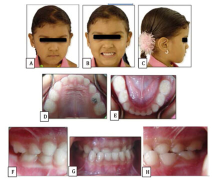 Figura 4. Registros iniciales de paciente de 7 años de edad sexo femenino con diagnóstico de relación esquelética Clase III por componente maxilar. A- Fotografía extraoral clínica frontal B-Fotografía en sonrisa de frente C- Fotografía de perfil D- Fotografía intraoral del maxilar superior E-Fotografía intraoral del maxilar interior F- Fotografía intraoral del lado derecho G-Fotografía intraoral en sonrisa de frente H-Fotografía intraoral de lado izquierdo Fuente: https://backup.revistaodontopediatria.org/ediciones/2014/1/art-9/