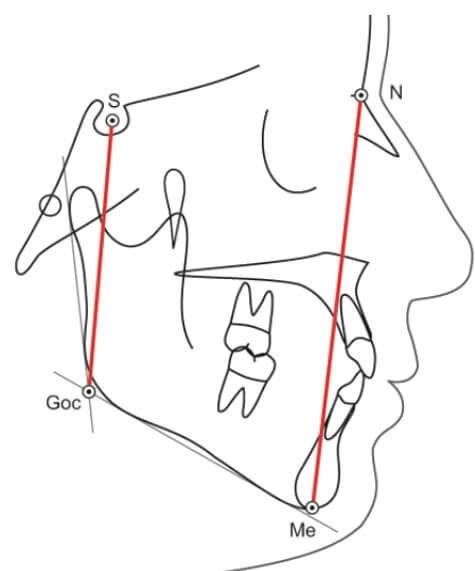 Figura 7. Análisis de Björk- Jarabak a través de la altura facial anterior (N-Me) y altura facial posterior (S-Go).