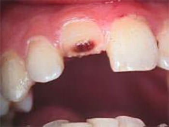 Fractura complicada de corona Imagen cortesía de www.odontocat.com