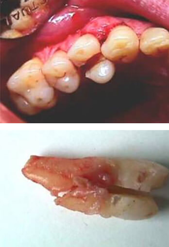Fractura de corona y raíz Imagen cortesía de www.odontocat.com