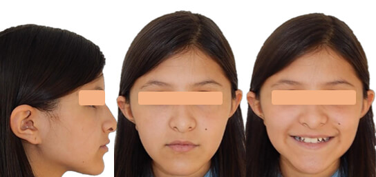 Fig. 1 perfil, frente en reposo, sonrisa