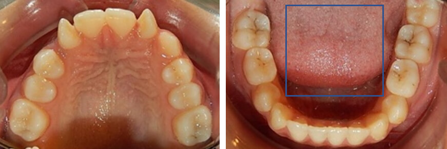 Fig. 4 vista oclusal arcadas.
