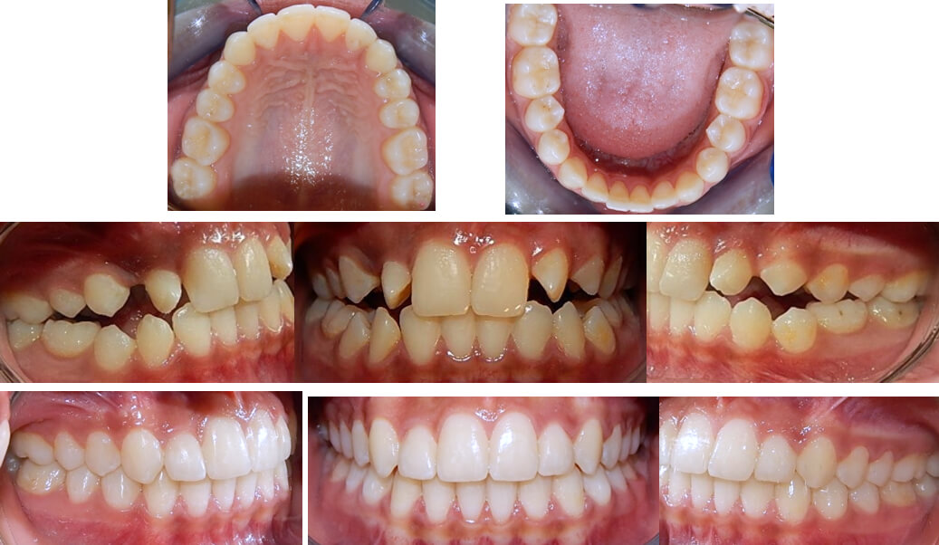 Fig. 6 comparación inicio final en oclusión