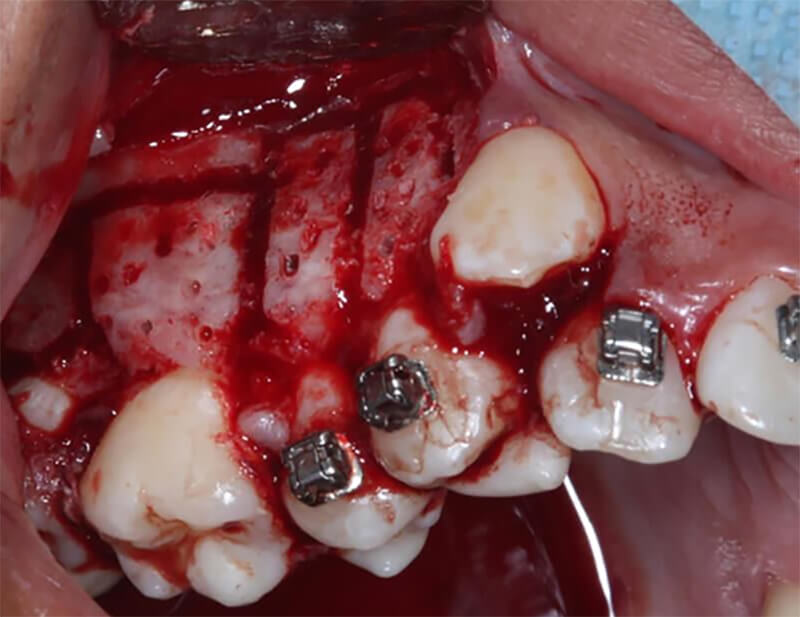 Fig. 1 Corticotomías para acelerar el movimiento de ortodoncia. Se realizan perforaciones para estimular el sistema de Havers y favorecer la migración celular. Tomado de https://www.ortodoncia.ws/publicaciones/2017/art-23/