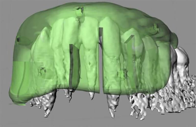 Figura 3. Diseño CAD del modelo de guía quirurgiuca 3D STL de la mandíbula utilizando Rhinoceros 3D software. Tomado de https://www.ncbi.nlm.nih.gov/pubmed/25840860