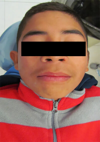 Fig. 1.- Fotografía extraoral, paciente sin malformaciones