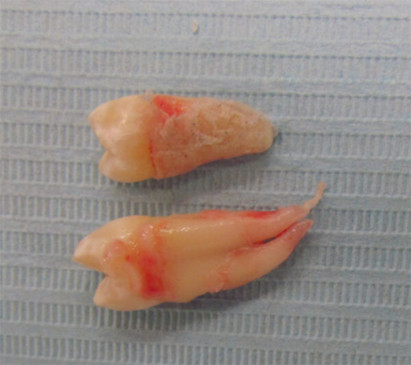 Fig. 5.- Dientes supernumerarios del cuadrante superior izquierdo.