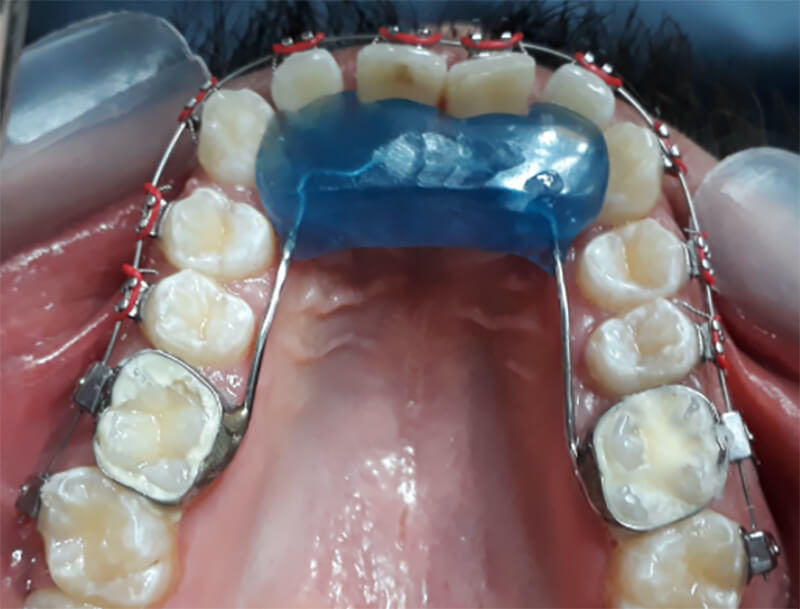 Fig. 6 Bite Plate para la corrección de la mordida profunda