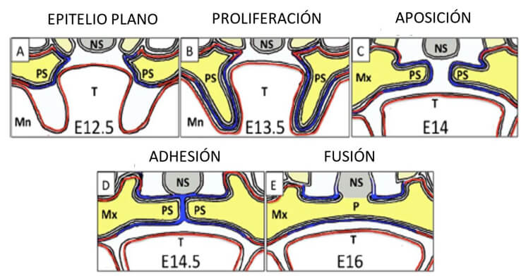Figura 5. Expresión de IRF6 durante las etapas de desarrollo palatino. A: El desarrollo palatal comienza en E12.5 (semana humana ≈7) con un epitelio palatino plano (azul) que expresa IRF6 y un mesénquima subyacente (amarillo). B: Un período de proliferación rápida conduce a la formación de los procesos palatinos junto a la lengua (T) y la mandíbula (Mn). IRF6 también se expresa en epitelio mandibular, lingual y maxilar (rojo). C: La reorientación de los procesos palatinos conduce a un pivote de la línea media y una suspensión horizontal sobre la lengua. D: la aposición de los procesos palatinos, seguida de la pérdida de peridermia, permite la adhesión o la interdigitación de las células epiteliales para producir la costura del borde medial. IRF6 se expresa tanto en peridermo como en células basales y se requiere para su fusión. E: La disolución del epitelio del borde medial, que se compone de células basales, conduce a la fusión de los procesos. Después de la fusión, un puente mesenquimatoso separa la cavidad nasal de la cavidad oral. Mn, mandíbula; Mx: Maxilar; NS: tabique nasal; P: paladar; PS: procesos palatinos; T: lengua. (Adaptado de Kousa & Schutte 15)
