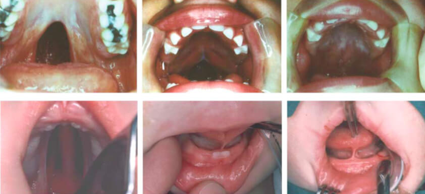 Ilustración 1. El fenotipo de HP ligada a X (CPX) es variable y se superpone con HP no sindrómicas. Panel superior: la imagen de la izquierda muestra el paladar blando hendido aislado en la madre con una deleción de base única en la región de codificación de TBX22. El hijo (centro) tiene una hendidura parcial menos severa pero también tiene anquiloglosia (no se muestra). La hija (derecha) tiene una hendidura parcial similar a la de su hermano, pero se muestra en el proceso de reparación. Al igual que la madre, no tiene anquiloglosia y es una fenocopia para la HP no sindrómica. Panel inferior: el fenotipo CPX masculino clásico es una hendidura completa del paladar secundario (imagen izquierda) y anquiloglosia (imagen central). La imagen de la derecha muestra la anquiloglosia en un hombre relacionado con la úvula bífida menos grave (no se muestra). Su hermano también porta la misma mutación pero tiene anquiloglosia solo sin HP (no se muestra) (Tomada de Kousa & Schutte 15).