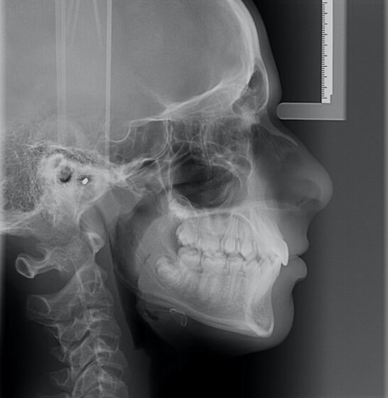 Fig.3. Foto radiografía teleradiografías de perfil