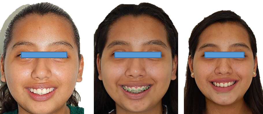 Fig. 12 sonrisa inicio progreso final.