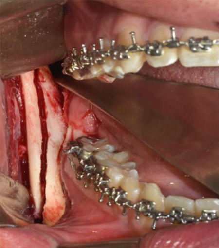 Fig. 6 OSBRM derecha