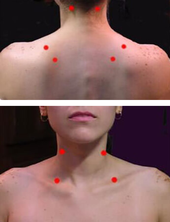 Figuras 1 y 2 Puntos gatillo que pueden ser fácilmente detectados por el odontólogo en cuello y espalda