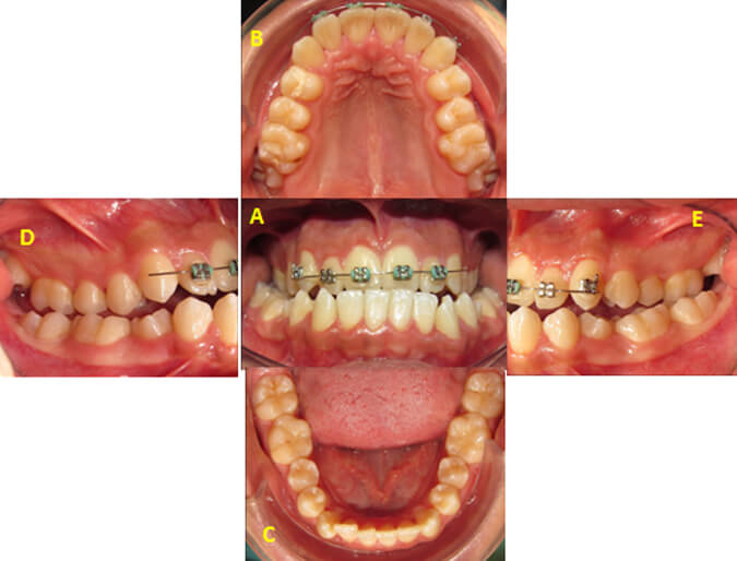 Figura 2. Fotografías intraorales A. Frontal B. Oclusal superior C. Oclusal inferior D. Lateral derecha E. Lateral izquierda