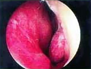 Hipertrofia de cornetes