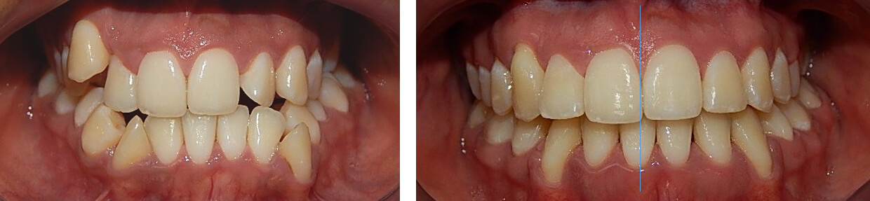 Fig. 12 Comparaciones inicio, final de frente 