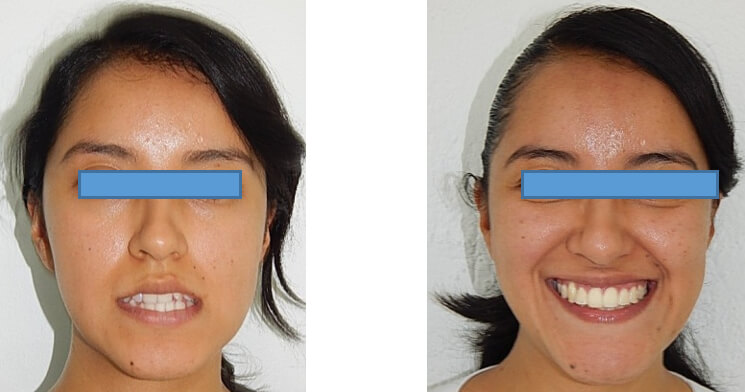 Fig. 13 comparación inicio y final