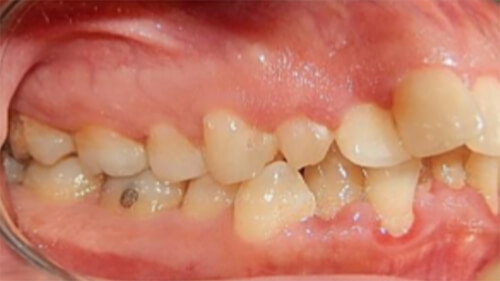 Fig.4 Intraoral derecha