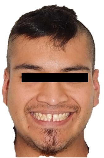 Fig. 2 Sonrisa
